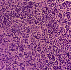 Nasopharyngeal carcinoma, nasopharynx cancer, microscopic show malignant tumor of atypical epithelial cells with prominent nuclei, most common cancer originating in the nasopharynx.