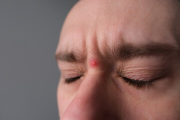 close up part of male face, guy, young man 25-30 years old closed his eyes, red pimple on the...