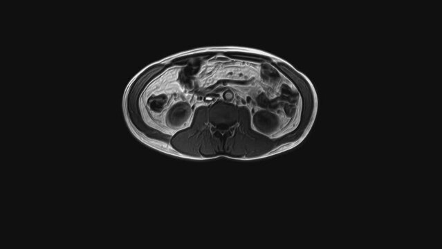 Voluminous CT scan of the abdomen. Computed tomography of the gastrointestinal tract, liver and kidneys