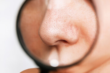Close-up of a female nose with blackheads or black dots in a magnifying glass on a white background. Acne problem, comedones. Enlarged pores on the face. Cosmetology dermatology concept