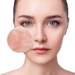 Young woman with couperose on face skin in zoom circle.