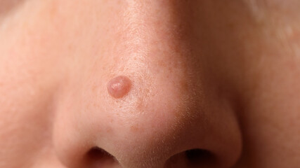 Mole or nevus on the nose on woman's face. Closeup.