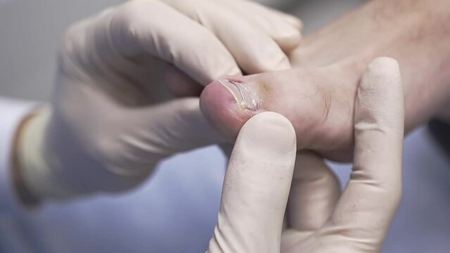 The doctor receives the patient in the office of the clinic of podology and orthopedics. Makes a primary examination feet, toes fungus, ingrown nails, flat feet. Therapeutic pedicure healthy nail