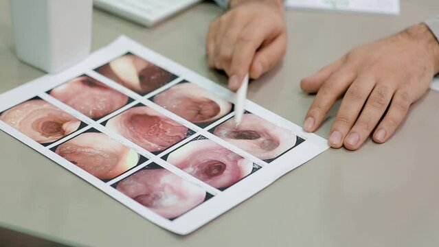 Closeup of doctor's hand pointing pen to endoscopic examination image with gastrointestinal diseases