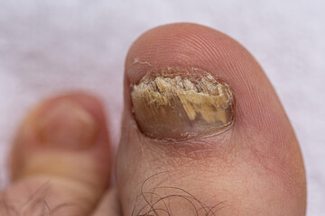 Feet of a man close-up of fingers affected by a fungal nail plate. Ugly toes.