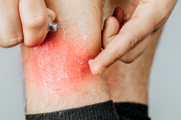 Application of therapeutic ointment for allergic rashes on the leg. Treatment of psoriasis, cosmetic and dermatological problems with ointment