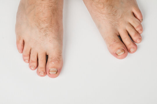 Fungal infection on the toenails of the foot, on a white background.
