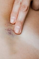 bruises and bruises on the girl's legs.