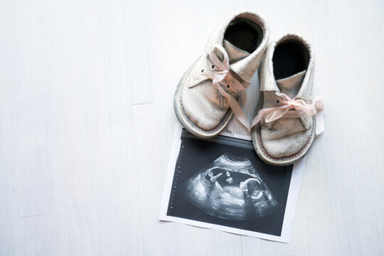 Pink baby girl shoes standing next to ultrasound image isolated on white background. To simulate pregnancy and newborn child.