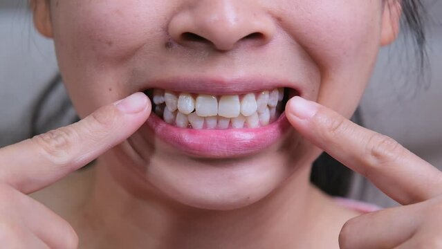 Asian woman smiles revealing white tooth spot, fluorosis in female teeth. Natural teeth of a middle age woman, jaw joint dysfunction. Health and dental care concepts.