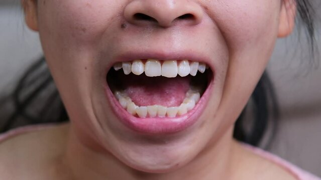 Asian woman smiles revealing white tooth spot, fluorosis in female teeth. Natural teeth of a middle age woman, jaw joint dysfunction. Health and dental care concepts.