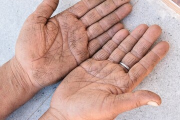 Dry cracked woman hand s showing eczema medical condition called dyshidrotic pompholyx or vesicular dyshidrosis