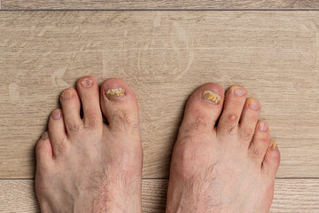 Feet of a man close-up of fingers affected by a fungal nail plate. Ugly toes.
