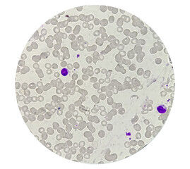Blood smear microscopic show Reactive lymphocytes and Neutropenia.