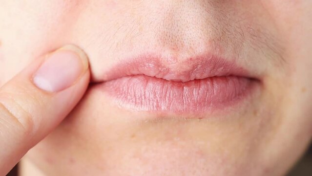 A young girl touches her black mustache above her upper lip, close-up. Increased testosterone in women.