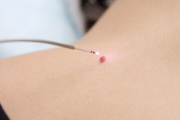 The laser wart removal procedure