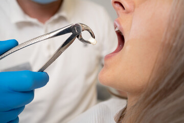 close-up of forceps for extraction of teeth and a tooth in them. The concept of going to the...