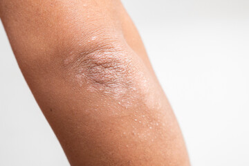 Fototapeta premium BRAZO DE HOMBRE CON PSORIASIS