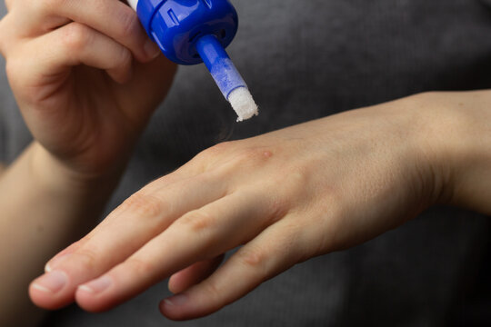 Closeup of a woman freezing a wart on her hand at home.