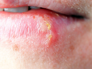 Fototapeta premium herpes on the lip of a woman