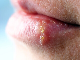 herpes on the lip of a woman