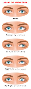 Strabismus or crossed eyes types - esotropia, exotropia, hypertropia, hypotropia. normal human eyes and eyes with problem. For medical publications. 