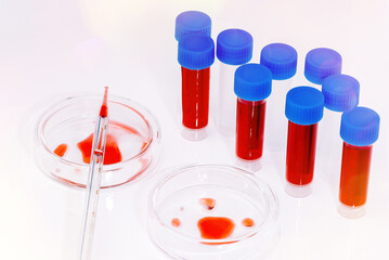 Medical laboratory. Coronavirus blood sample COVID-19. Petri dish and test tubes with blood in the laboratory. Blood coronavirus test.Virus vaccine development.Pipette and petri dish.Virus research.
