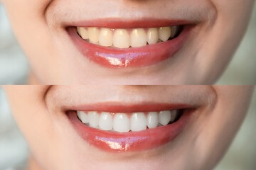 Woman teeth before and after whitening. Looking at camera. Dental clinic patient.
