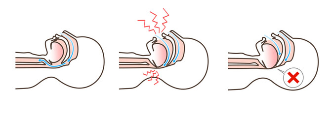 いびきの図解イラスト © K.Nakano