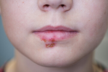 herpes on the lips of a boy close-up - obrazy, fototapety, plakaty