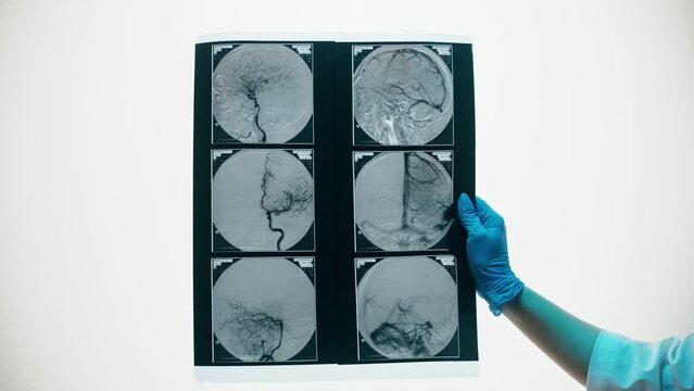 X-ray, Magnetic resonance image of head. Doctor examining blood vessels, human brain MRI close-up. Advanced research of body, checkup tomography. 