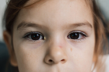 Close up of child ill with conjunctivitis, red eye with pus