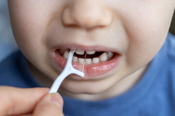 a boy is cleaning his teeth with a toothpick. plastic dental floss. close up photo. kid has diastema. space between teeth. stomatological concept. dental care, family education.