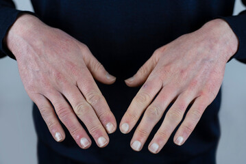 The hands of a mature man close up - the skin is very dry and cracked from the cold and wind, in...