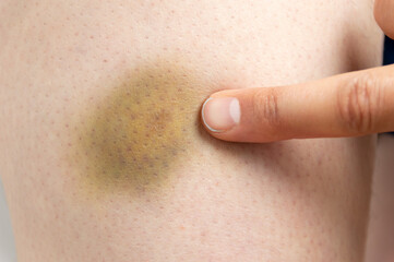 Close-up image of a doctor who indicates with a finger the bruise on the skin as a result of a blow...