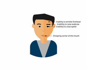 Bell’s palsy symptom of the disease 