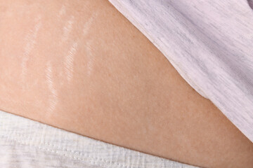Female body with stretch marks on the abdomen after childbirth close-up. Changes in the skin, scars...