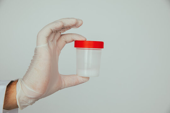 Doctor holding a plastic jar with sperm for semen analysis. Medical test in hospital