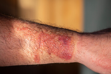 blistering of the forearm due to a phytophotodermatitis reaction caused by intense contact with a...