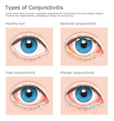 Three types of conjunctivitis and healthy eye medical vector illustration. 