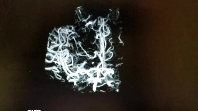 CT Brain angiography - rotating frontal image in black, white