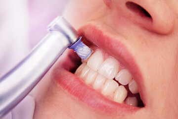 Close-up professionelle Zahnreinigung / die Zähne einer Frau werden poliert