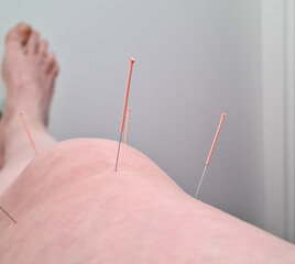 Therapy of female knee with pricking acupuncture needles. close-up. Real photo. Selective focus on...