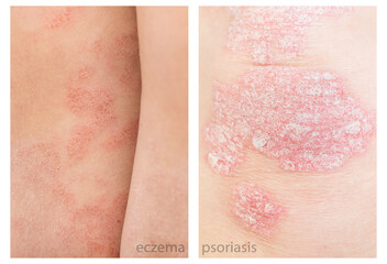 Close up difference between Psoriasis and Eczema, atopic dermatitis. Chronic skin disease