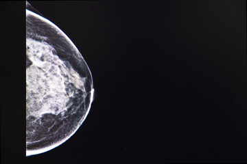 Breast Mammography, X-ray of woman's breast for early identification of breast cancer