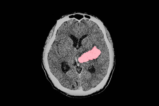 A computer tomography image of brain and skull showing large intracerebral hemorrhage or hemorrhagic stroke.