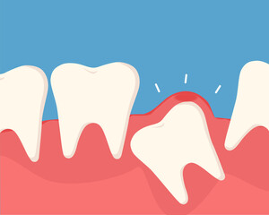 Inflammation of the tooth under the gum causes pain in the mouth. The concept of dental care. Vector