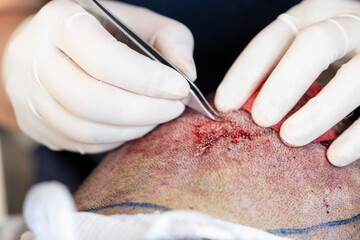 Obraz na płótnie Canvas Hair transplant treatment.Surgeon collects hair follicles.Baldness operation.