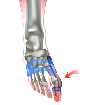 Hallux valgus of the human foot. Protruding thumb bones. Bus to fix the problem. Vector illustration