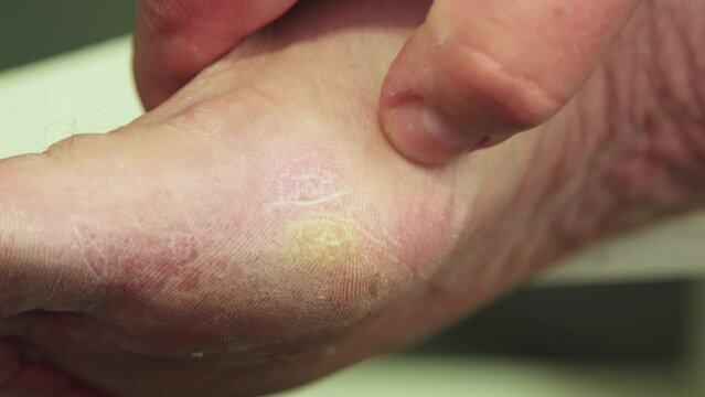 A hand is massaging a man's foot with a callus. We do the pedicure ourselves. Self-care for your feet. Isolated video, close-up. Warm, soft light. UHD 4K.
